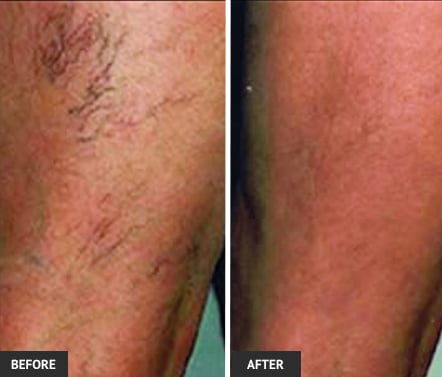 spiderveins