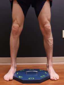 Before Image: EVLT – Sclerotherapy