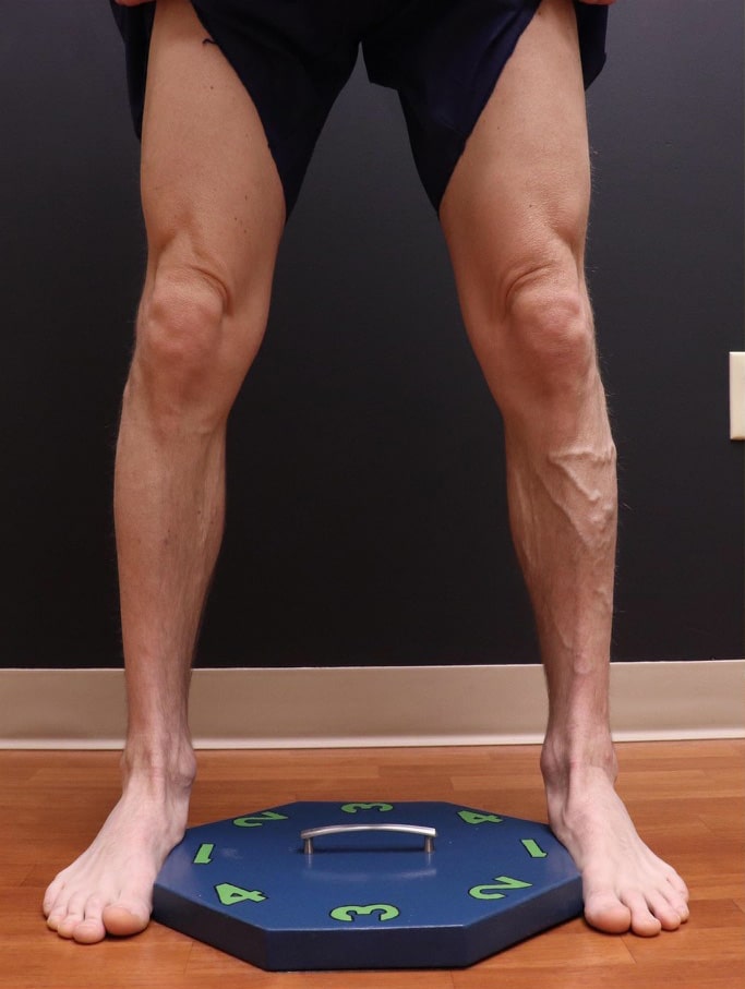 Before Image: EVLT – Sclerotherapy - front