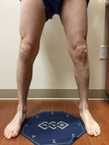 After Image: EVLT – Sclerotherapy