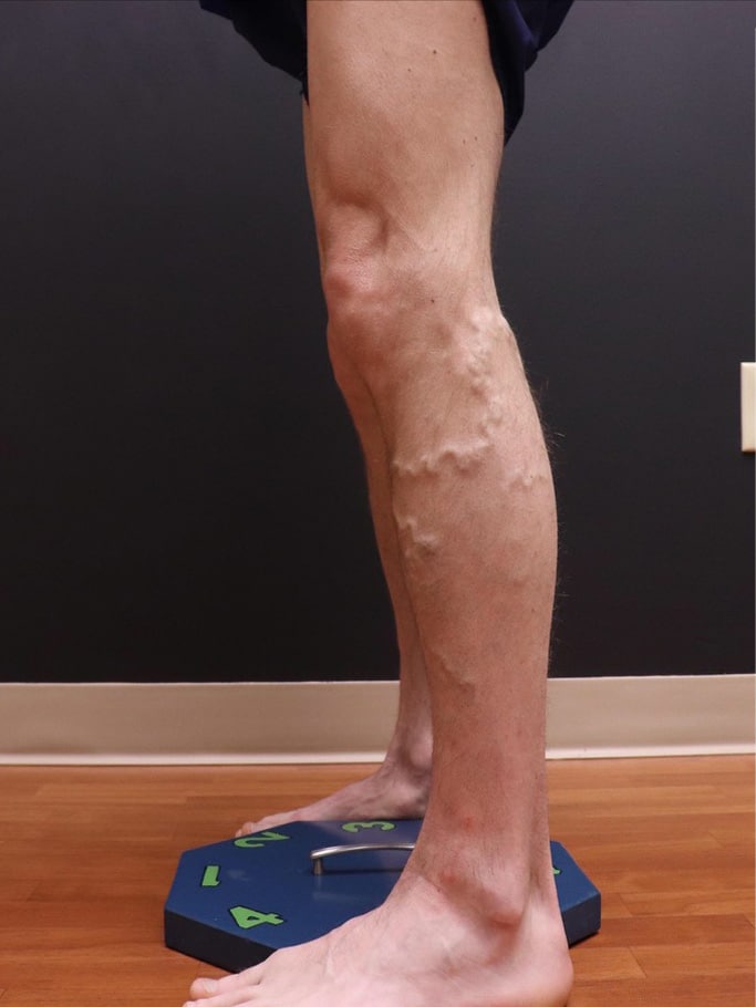 Before Image: EVLT – Sclerotherapy - left-side