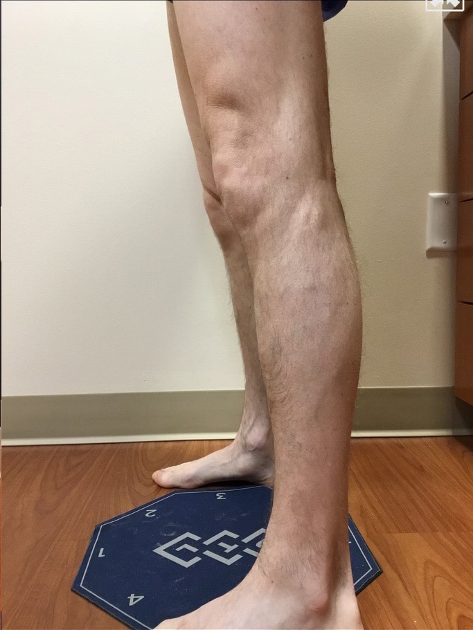 After Image: EVLT – Sclerotherapy - left-side