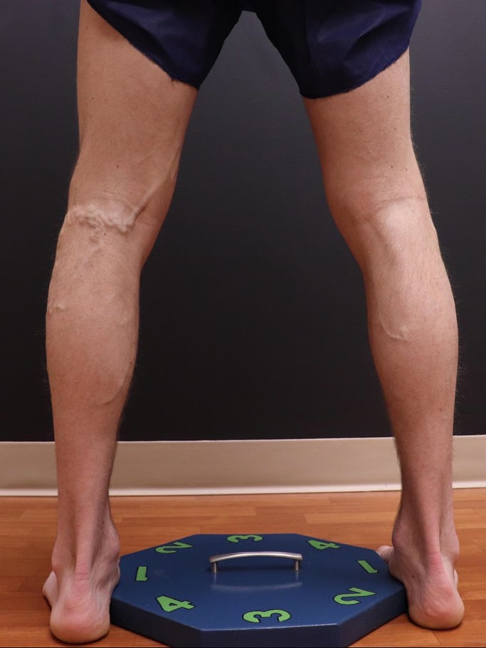 Before Image: EVLT – Sclerotherapy - back