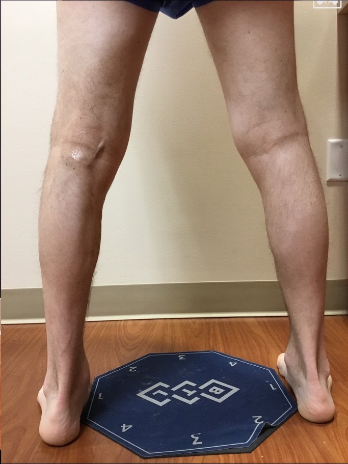 After Image: EVLT – Sclerotherapy - back