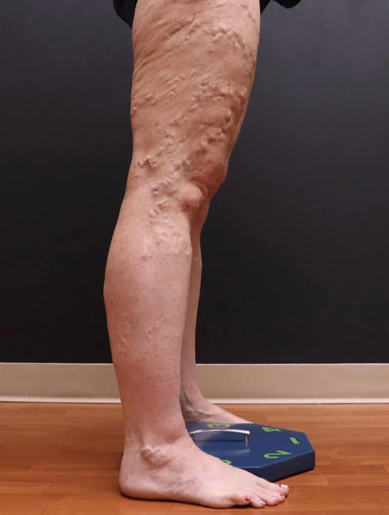 Before Image: EVLT – Sclerotherapy - right-side