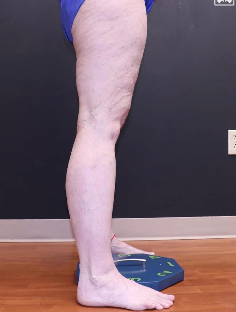 After Image: EVLT – Sclerotherapy - right-side
