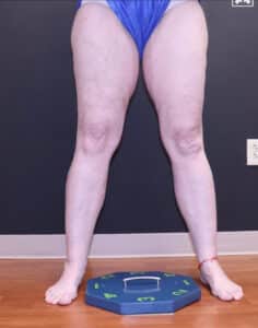 After Image: EVLT – Sclerotherapy