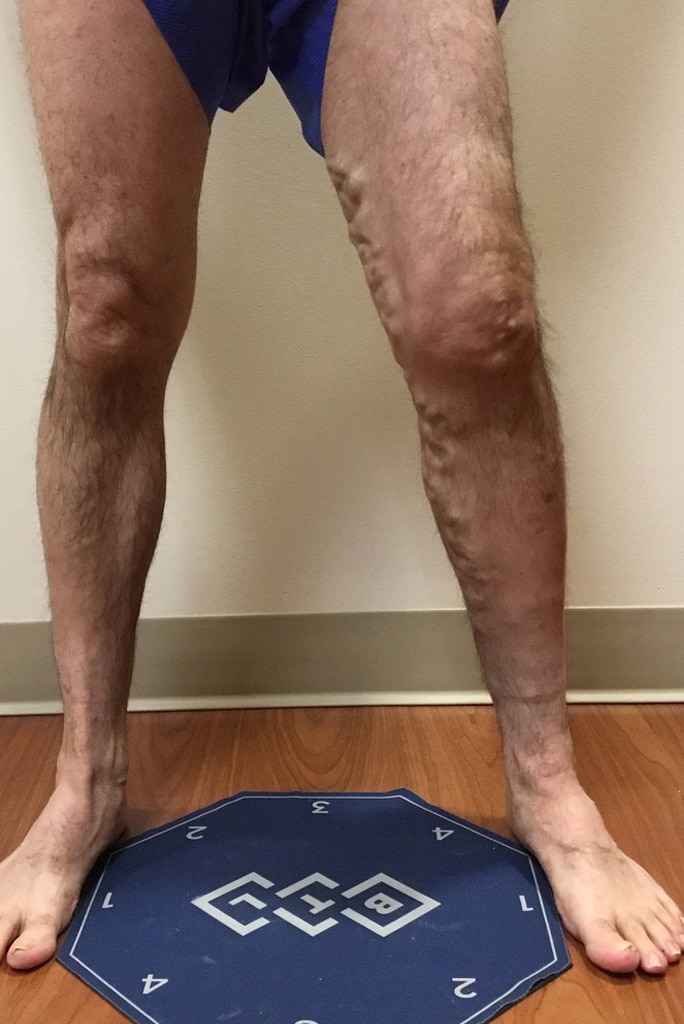 Before Image: EVLT – Sclerotherapy - front