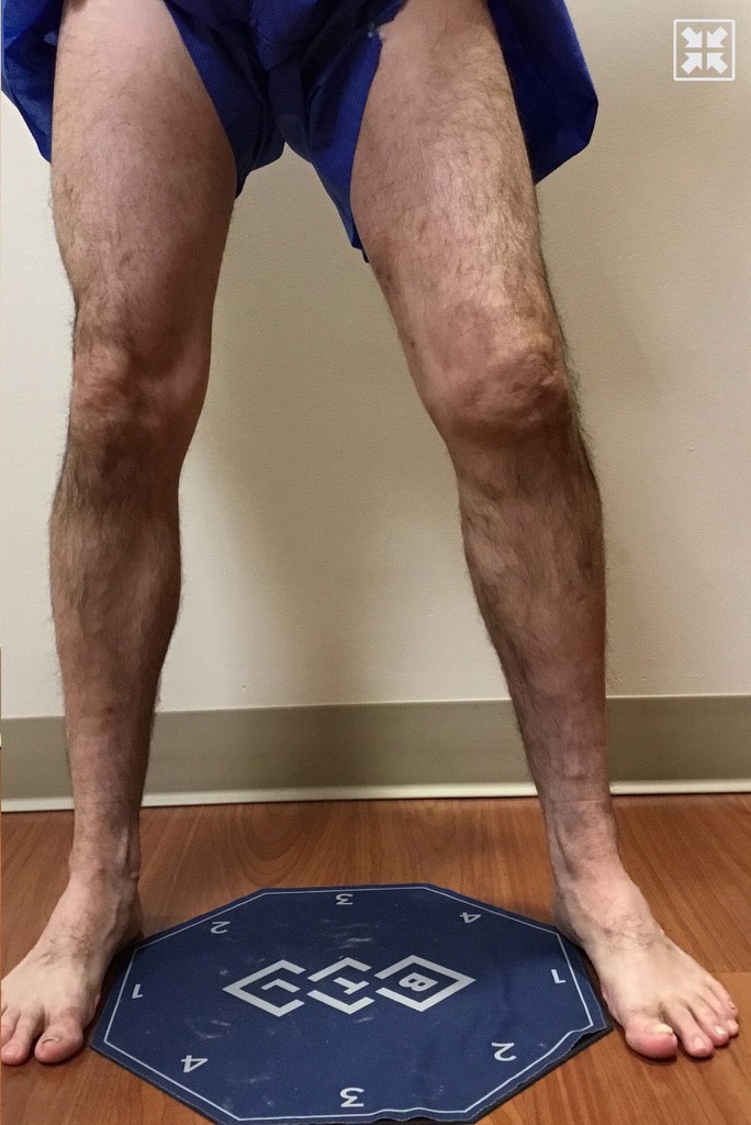 After Image: EVLT – Sclerotherapy - front