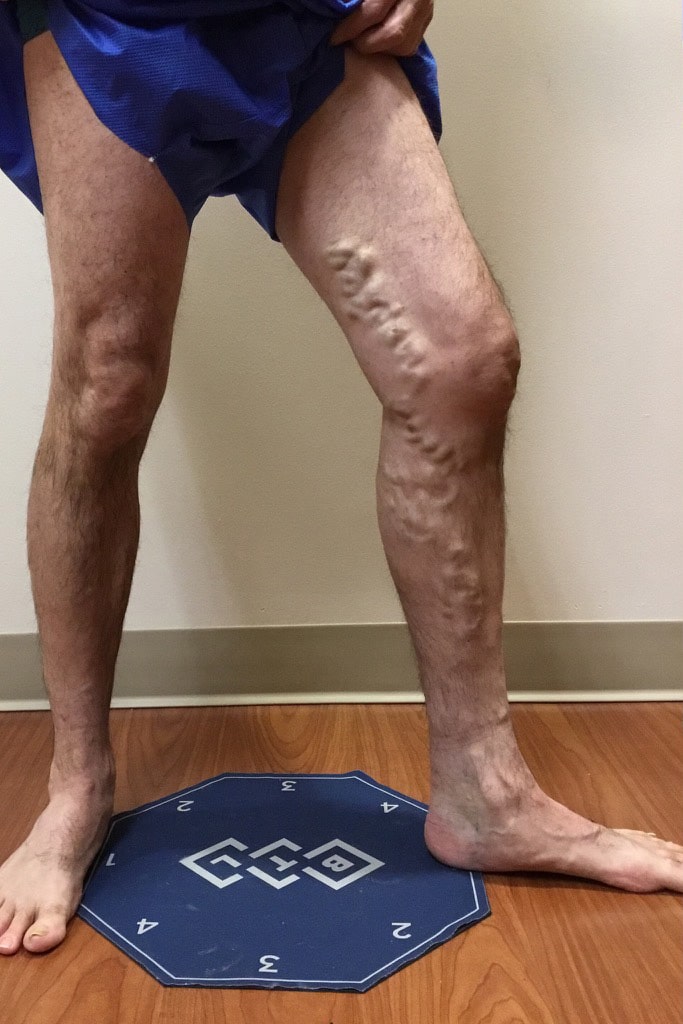 Before Image: EVLT – Sclerotherapy -