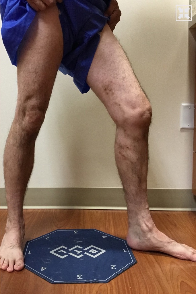 After Image: EVLT – Sclerotherapy -