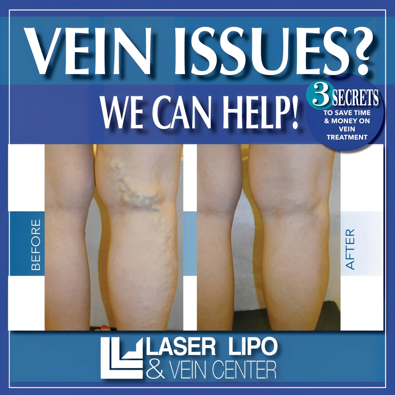 LLVC 2024 1 January Vein Treatment 800x800 3 SECRETS 2048x2048 (1)