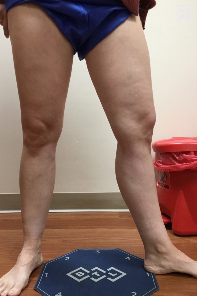 After Image: Varicose Vein - front