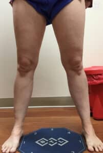 After Image: Varicose Vein