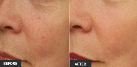 veinwave for cheek veins