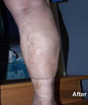 After Image: EVLT – Sclerotherapy - other