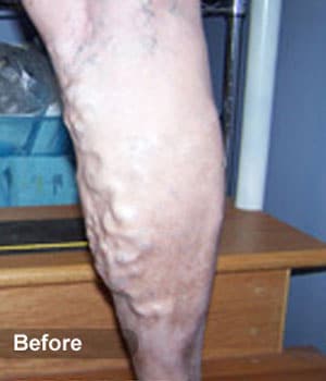 Before Image: EVLT – Sclerotherapy - other