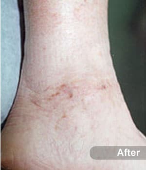 After Image: EVLT – Sclerotherapy - other