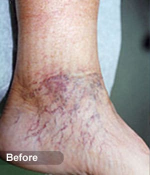 Before Image: EVLT – Sclerotherapy - other