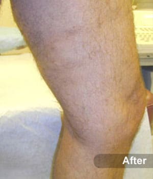 After Image: EVLT – Sclerotherapy - other