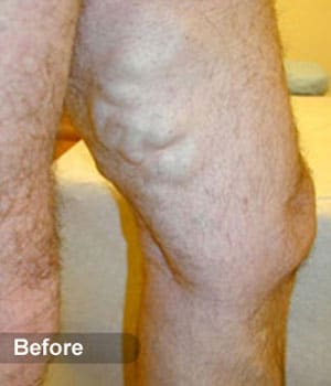 Before Image: EVLT – Sclerotherapy - other