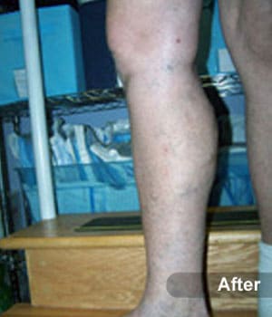 After Image: EVLT – Sclerotherapy - other
