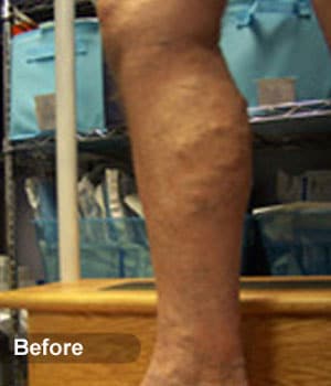 Before Image: EVLT – Sclerotherapy - other