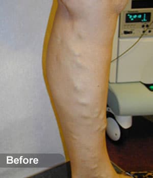 Before Image: EVLT – Sclerotherapy - other