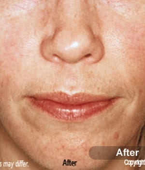 After Image: EVLT – Sclerotherapy - front