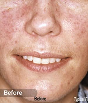 Before Image: EVLT – Sclerotherapy - front