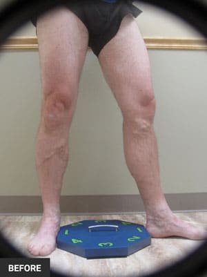 Before Image: EVLT – Sclerotherapy - right-front-oblique