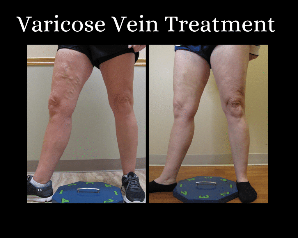 Varicose Vein Treatment Before and After St Louis Dr Wright