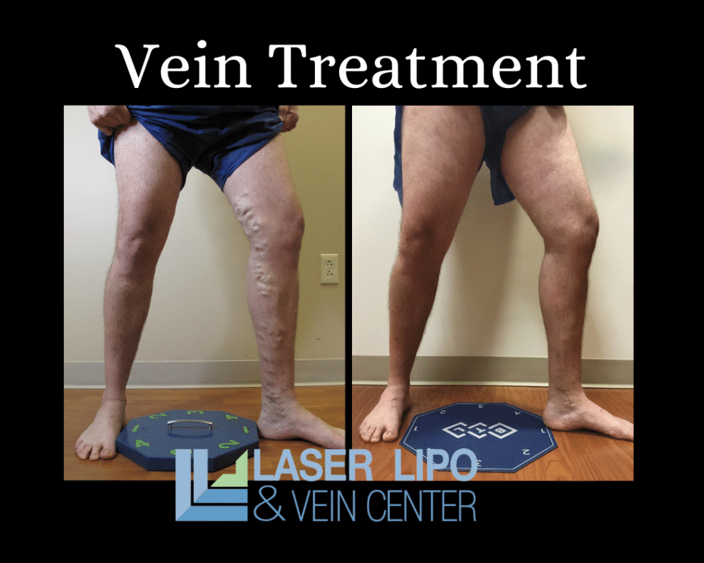 Vein Treatment Before and After St Louis Dr Wright