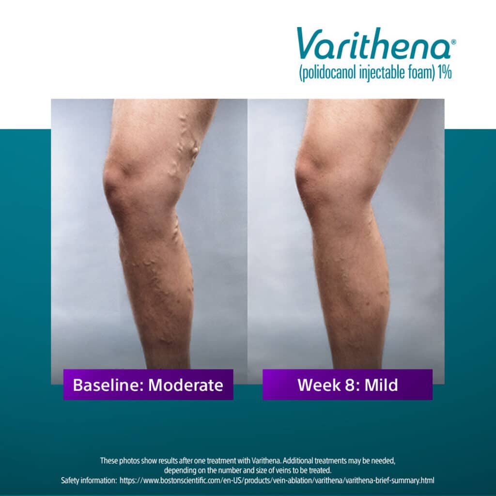 Varithena Before & After Varicose Vein Images 1080x1080