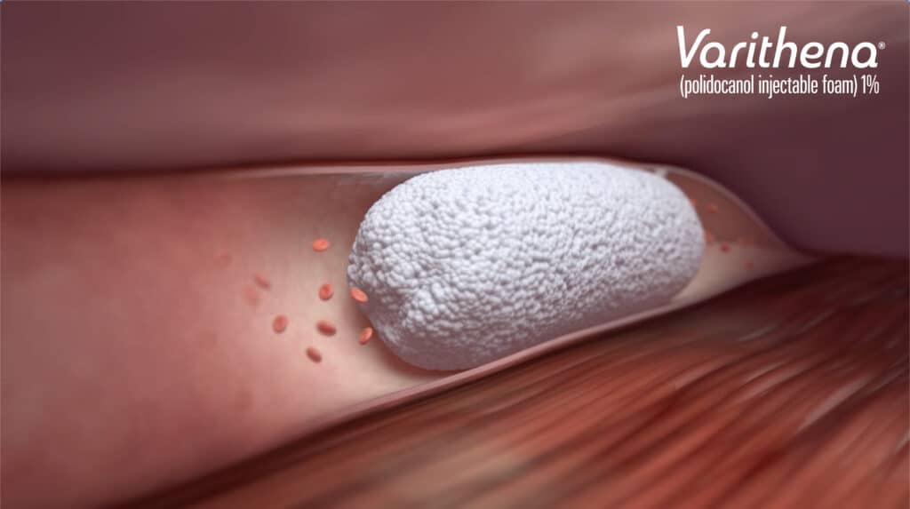 Varithena in vein Image