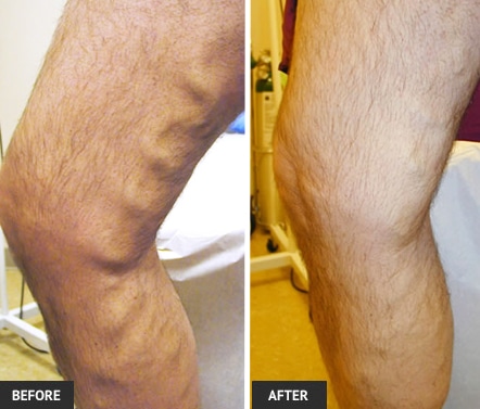 evltbeforeafter